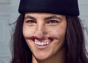 Modelo atacada no rosto por cão dá a volta por cima