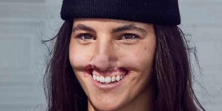 Modelo atacada no rosto por cão dá a volta por cima