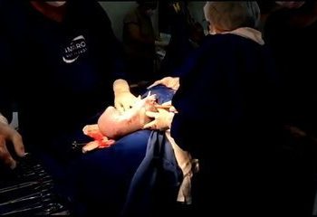 Bebê nasce empelicada e rompe bolsa com a própria mão, em Goiânia; vídeo