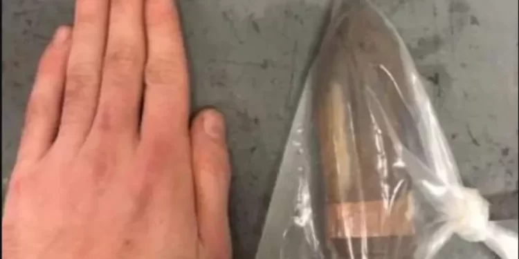 Homem com projétil de canhão no reto faz hospital acionar equipe antibomba