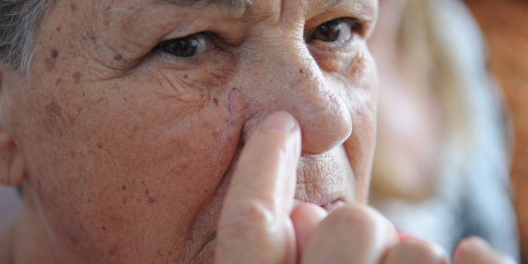 Dificuldade para se bronzear indica predisposição ao câncer de pele