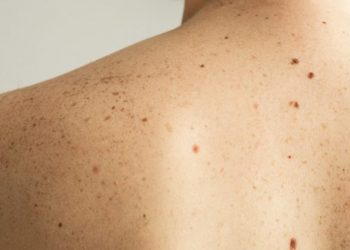 Dezembro chega com um alerta: fique atento ao câncer de pele