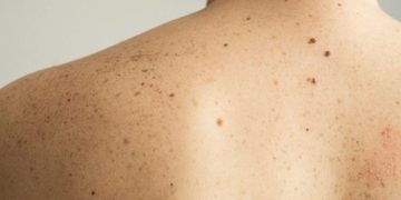 Dezembro chega com um alerta: fique atento ao câncer de pele