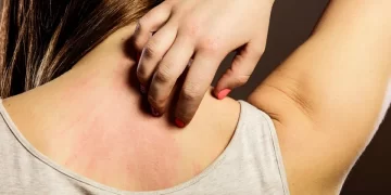 Surto de lesões que provocam coceira tem mariposas como causa, afirma Sociedade Brasileira de Dermatologia