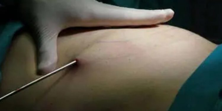 Sem saber, filha grava morte da mãe após lipo: “Não imaginava”