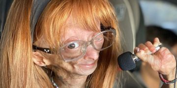 Morre aos 15 anos Adalia Rose, youtuber com ‘síndrome de Benjamin Button’ que tinha milhões de seguidores