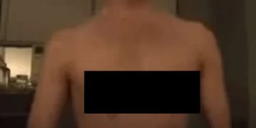 Um adolescente de 15 anos perdeu os dois mamilos, ao participar do “desafio do desodorante’’ pela internet. Ele despejou duas latas de spray do produto no peito.