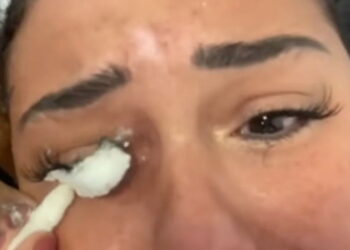 Mulher sofre queimaduras após realizar alongamento de cílios