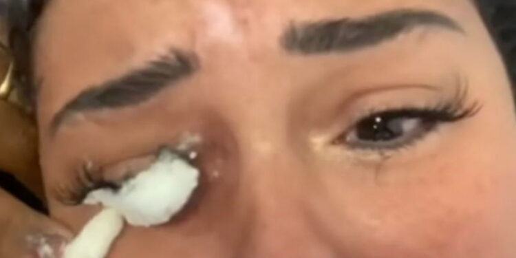 Mulher sofre queimaduras após realizar alongamento de cílios