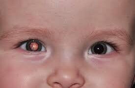 Retinoblastoma: entenda o que é e como identificar os sinais