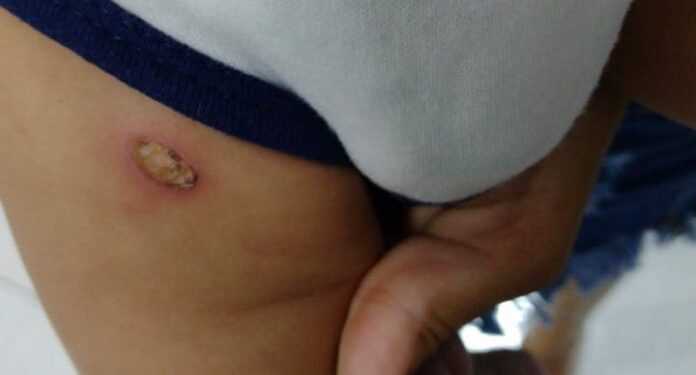 Suspeito de torturar bebê com bituca de cigarro é preso