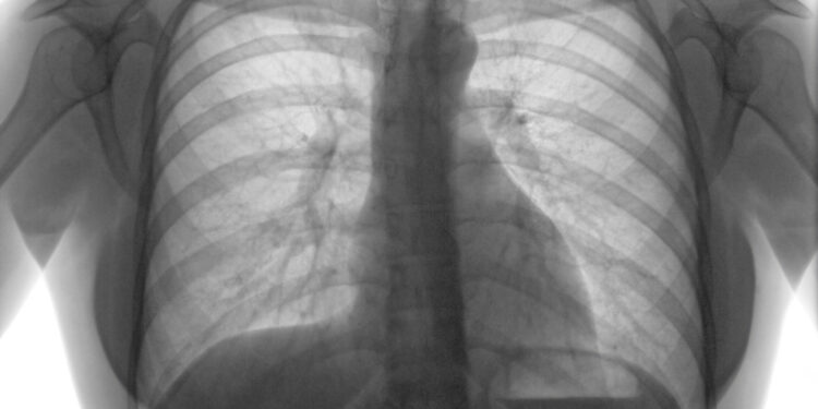 Prefeitura promove ações de prevenção contra a tuberculose