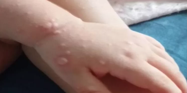 Surto da doença conhecida como mão-pé-boca é confirmado em duas cidades de MT