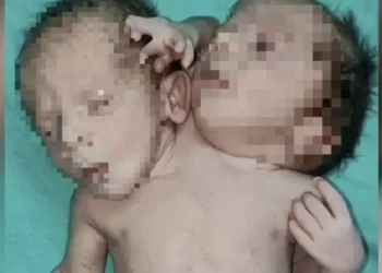 Gêmeos nascem com mesmo tronco, três braços e dois corações na Índia