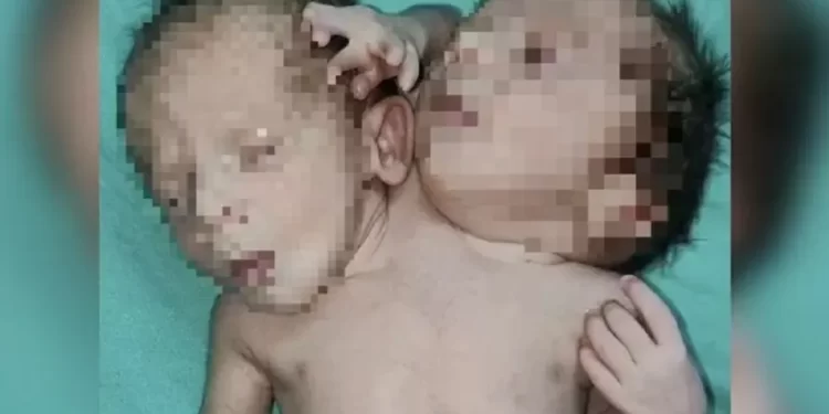 Gêmeos nascem com mesmo tronco, três braços e dois corações na Índia