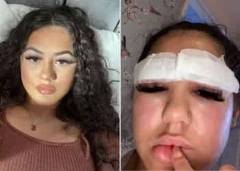 Jovem perde pelos das sobrancelhas após reação alérgica a procedimento