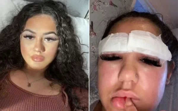 Jovem perde pelos das sobrancelhas após reação alérgica a procedimento