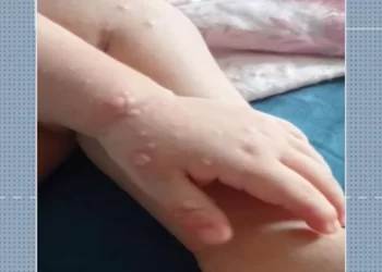 Prefeitura faz alerta sobre casos de doença ‘mão-pé-boca’ em Ponta Grossa