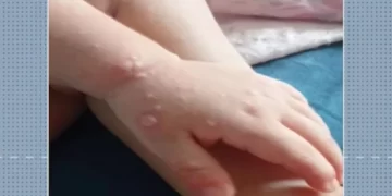 Prefeitura faz alerta sobre casos de doença ‘mão-pé-boca’ em Ponta Grossa